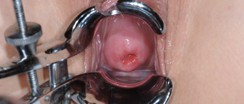 CERVIX
